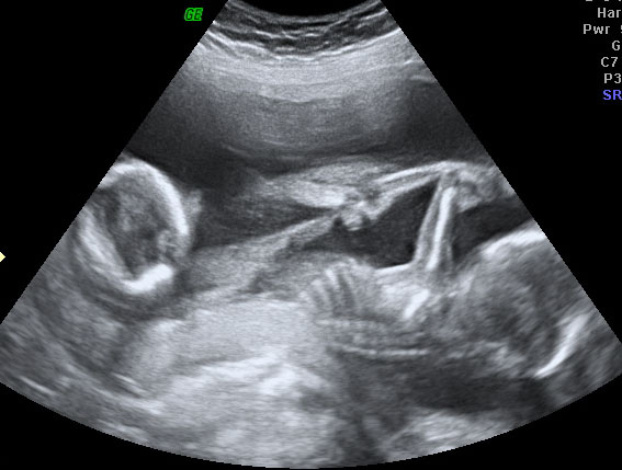 Ultrasound Pictures Of Twins Only 98